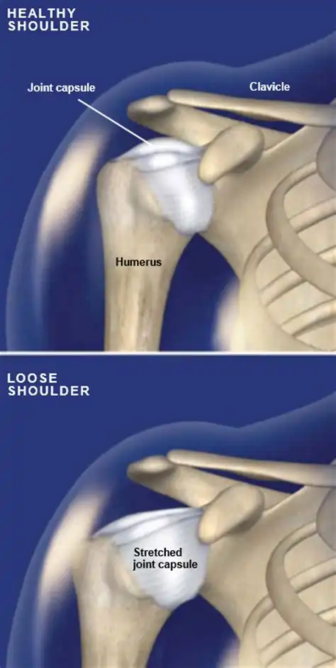 ناپایداری مفصل شانه ناپایداری مفصل شانه