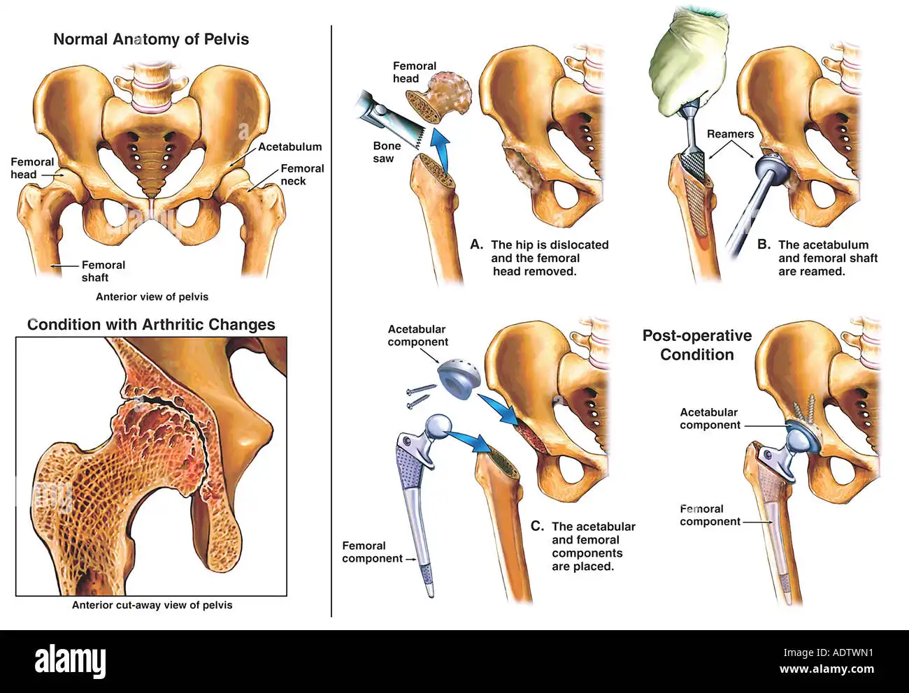 فیلم تعویض مفصل ران لگن