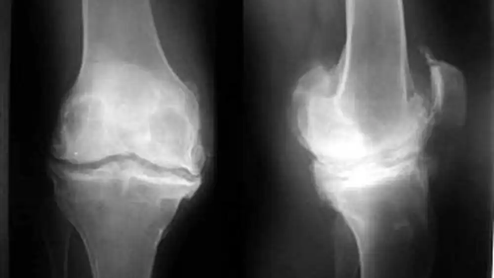 استئوفیت و خار استخوانی چیست استئوفیت