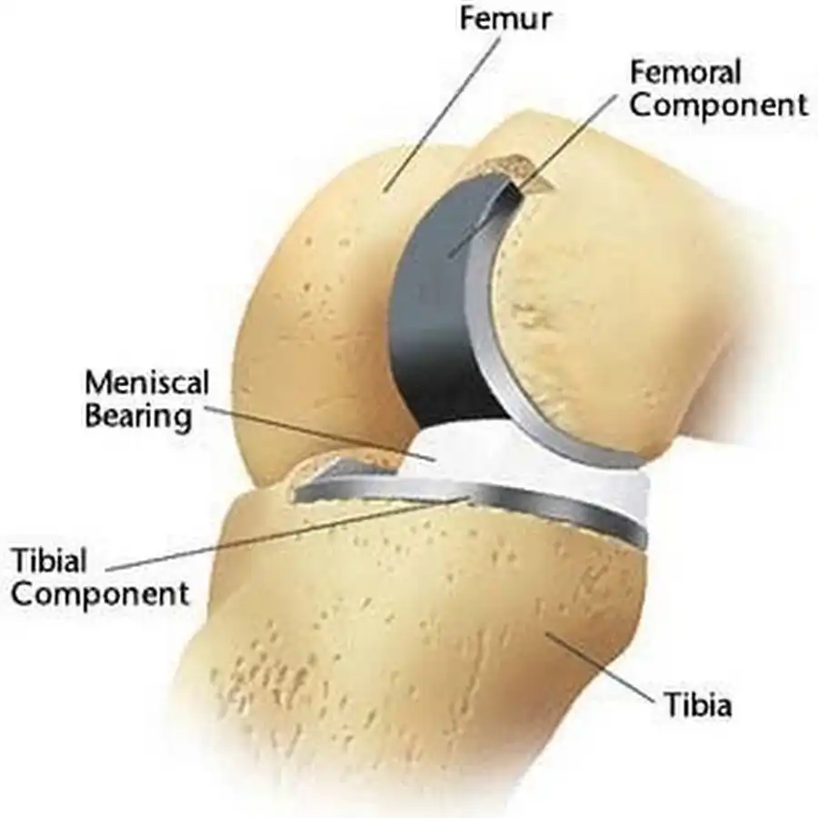 روش جراحی تعویض مفصل زانو فیلم عمل تعویض مفصل زانو