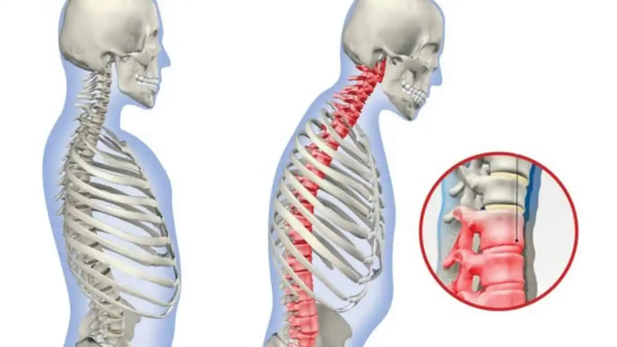 تغییرات دژنراتیو ستون فقرات تغییرات دژنراتیو ستون فقرات