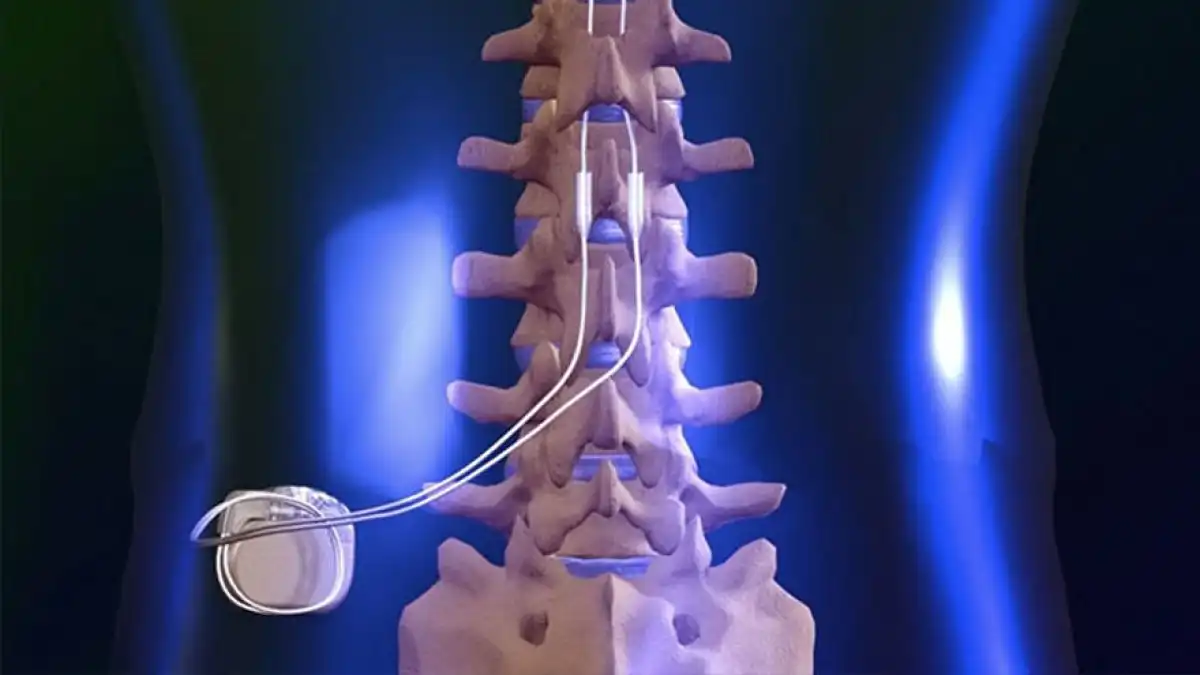ایمپلنت ستون فقرات ایمپلنت ستون فقرات