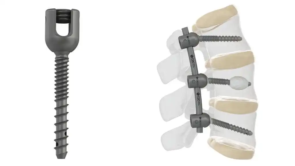 ایمپلنت ستون فقرات ایمپلنت ستون فقرات