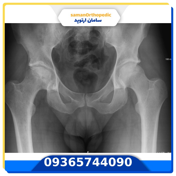 عمل آرتروز مفصلی