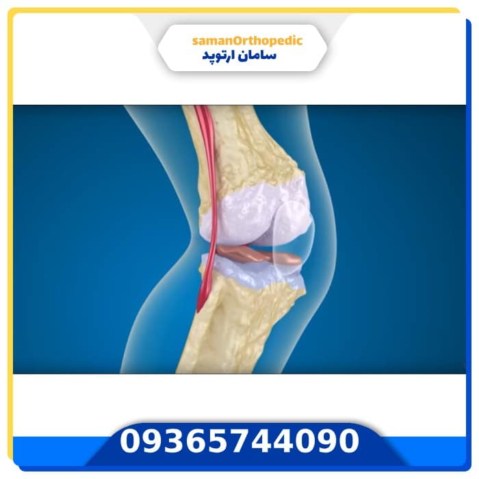 عمل آرتروز مفصلی