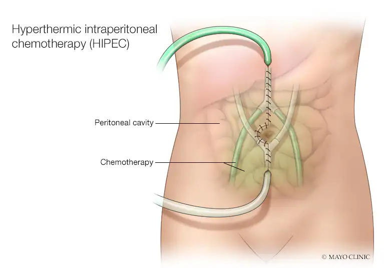 طول عمر سرطان ستون فقرات طول عمر سرطان ستون فقرات