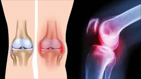 چرا مفصل زانو درد میکند ؟ چرا مفصل زانو درد میکند ؟