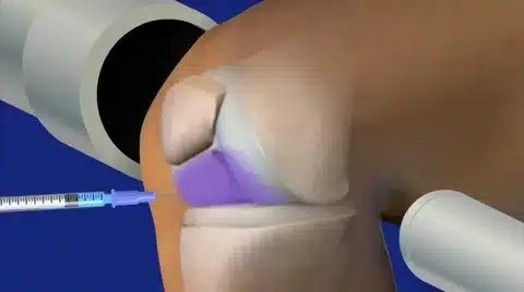 عفونت مفصل زانو در کودکان