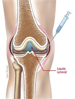 تزریق تریامسینولون در مفصل زانو عوارض تزریق کورتون به مفصل زانو