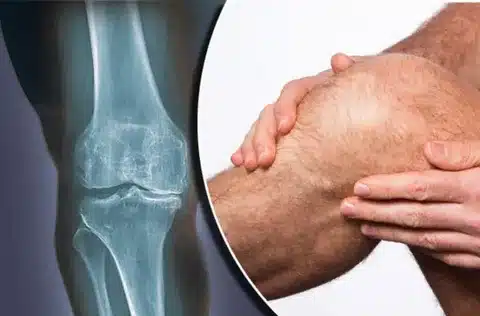 چرا مفصل زانو درد میکند ؟ چرا مفصل زانو درد میکند ؟