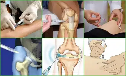 هزینه پروتز مفصل زانو