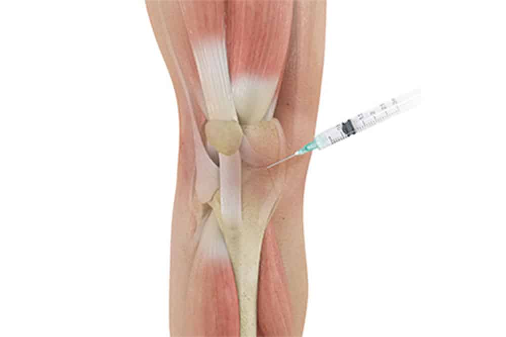 عفونت مفصل زانو چیست