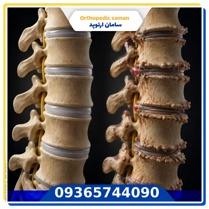 علت تغییرات دژنراتیو ستون فقرات چیست؟