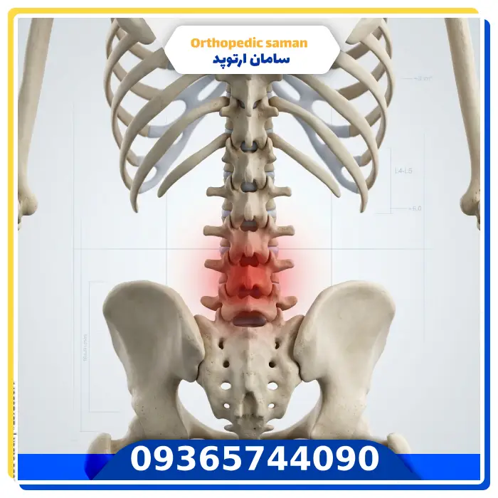 نقش فیزیوتراپی و حرکات اصلاحی در پیشگیری از کیفوز مهره‌ها