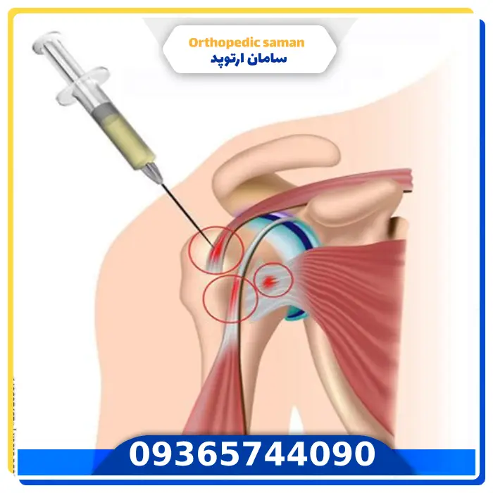 آرتروز شانه یا مفصل آکرومیوکلاویکولار