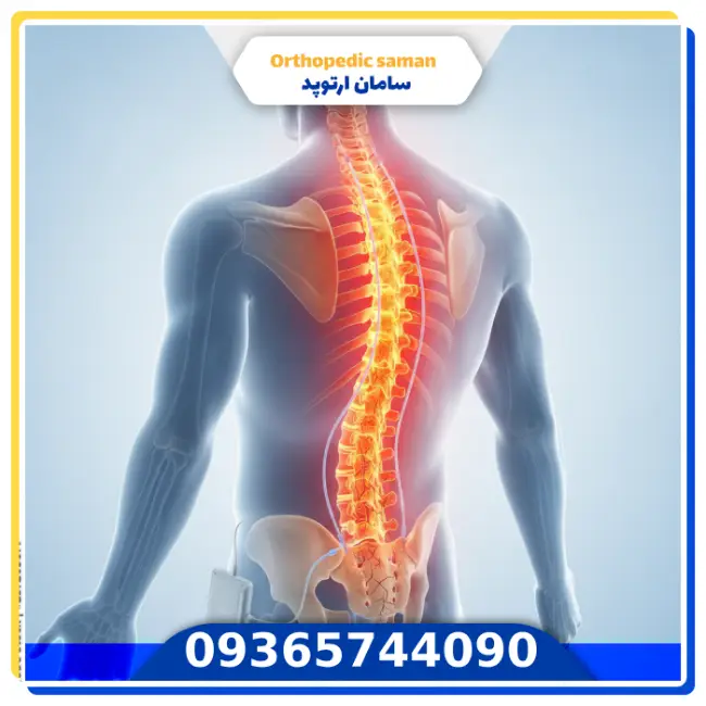 روش‌های دارویی، گیاهی و سنتی برای کنترل روماتیسم ستون فقرات
