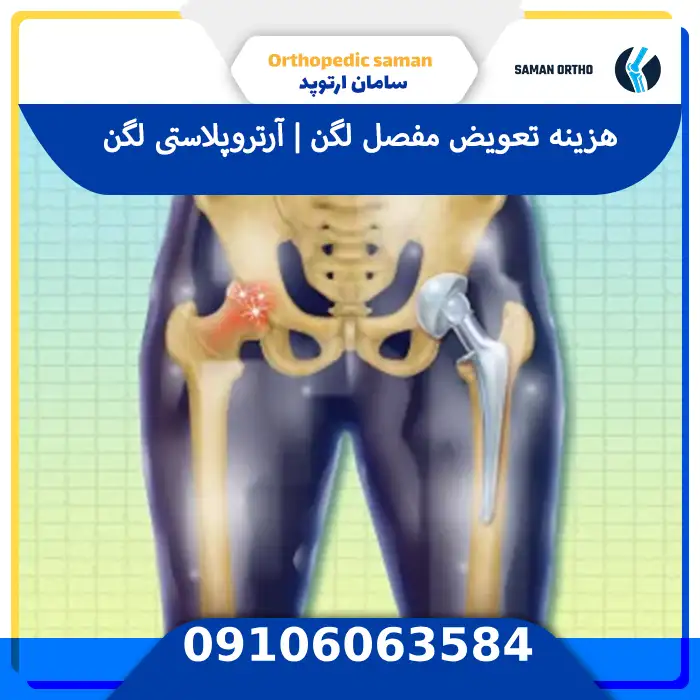 هزینه تعویض مفصل لگن