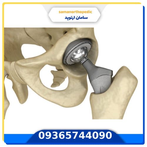 پروتز مفصل لگن آمریکایی