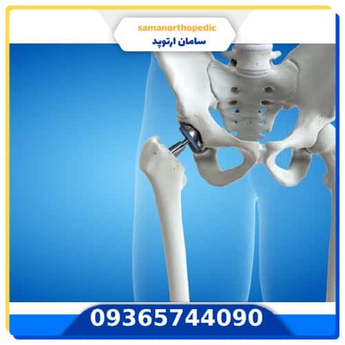 پروتز مفصل لگن آمریکایی