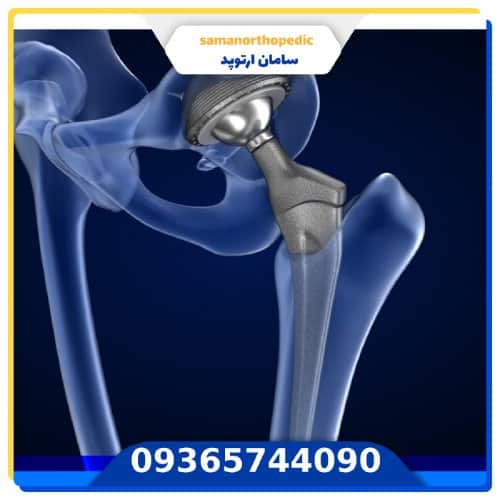 پروتز مفصل لگن آمریکایی