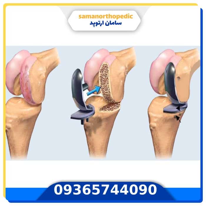 پروتز مفصل زانو آمریکایی