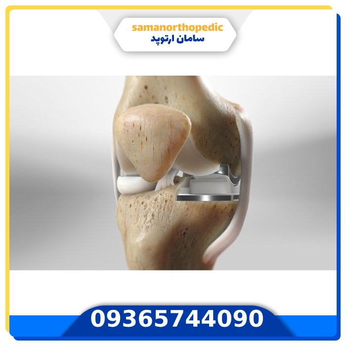 پروتز مفصل زانو آمریکایی