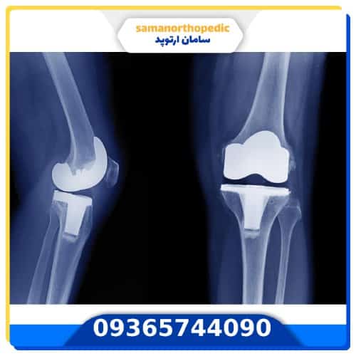 پروتز مفصل زانو آمریکایی