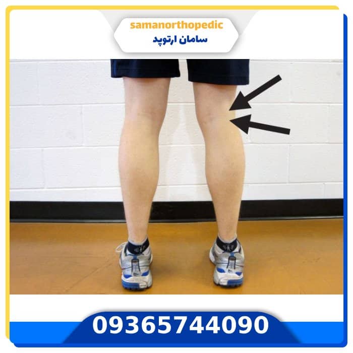 علت انحراف زانو چیست