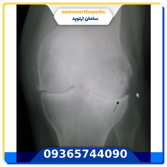 علت انحراف زانو چیست