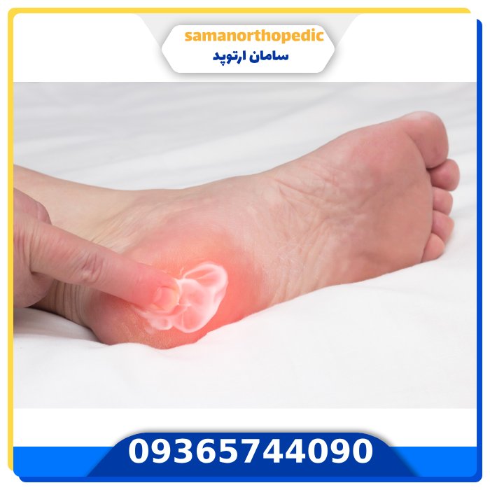 استئوفیت و خار استخوانی چیست