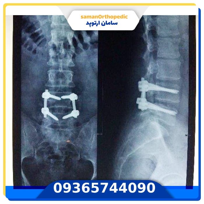 معرفی انواع روش های عمل دیسک کمر