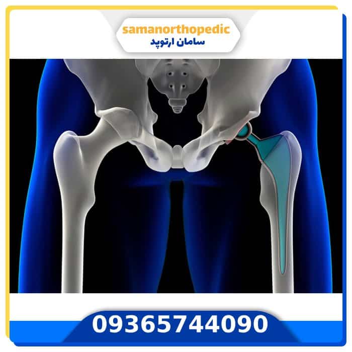 درمان درد مفصل ران و لگن
