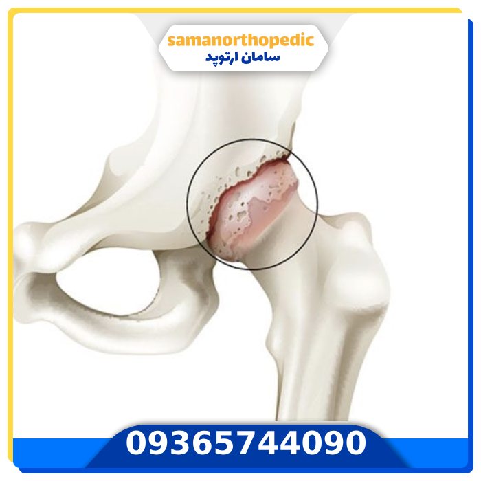 پیوند مفصل لگن چیست