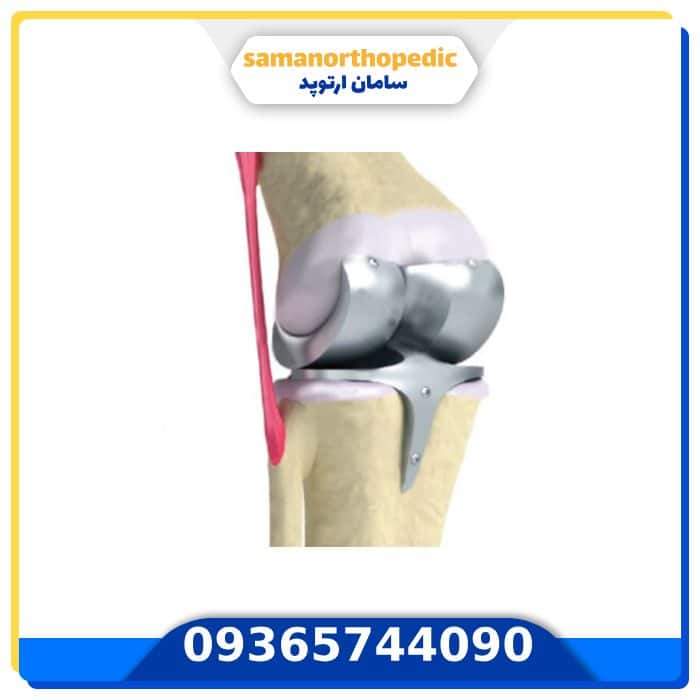 عمل تعویض مفصل زانو: آیا واقعاً یک سال طول میکشد؟