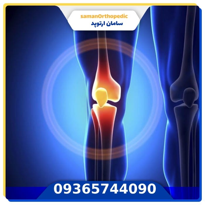 عمل جراحی تعویض مفصل زانو