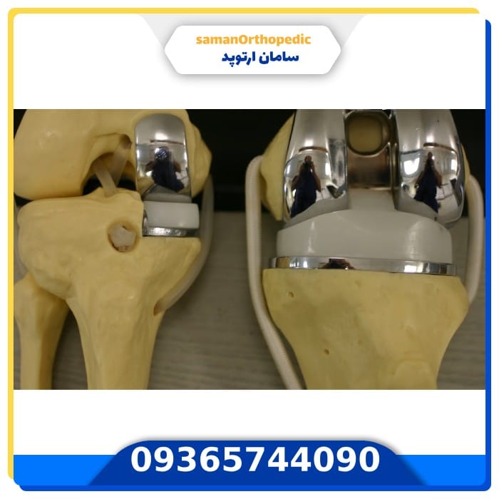 عمل جراحی تعویض مفصل زانو