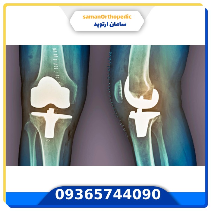 عمل جراحی تعویض مفصل زانو
