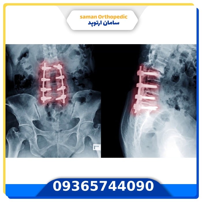 سامان ارتوپد با شماست تا عمل جراحی دیسک کمر