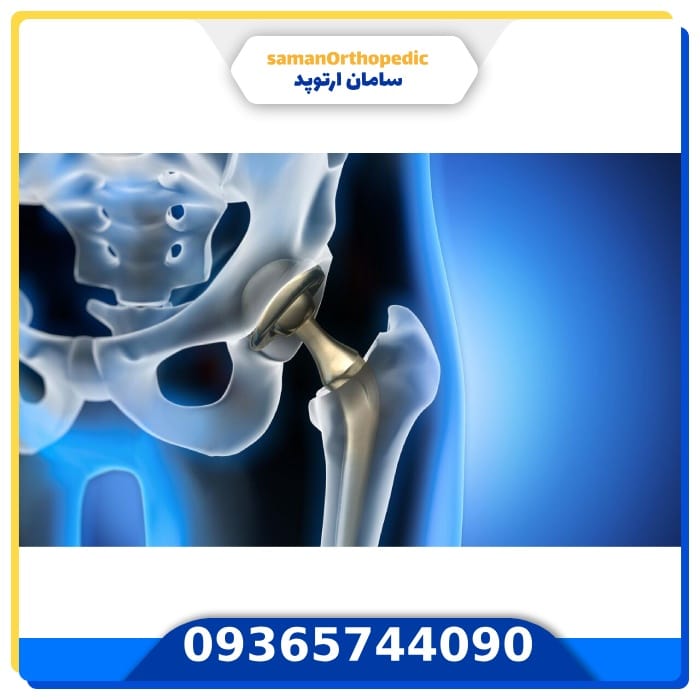 عمل جراحی تعویض مفصل لگن