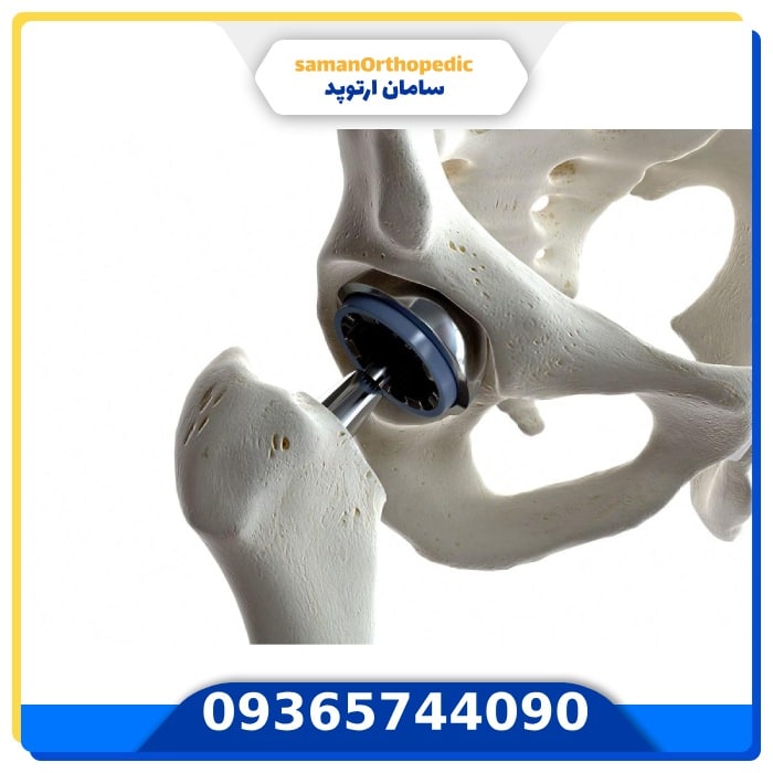 عمل جراحی تعویض مفصل لگن