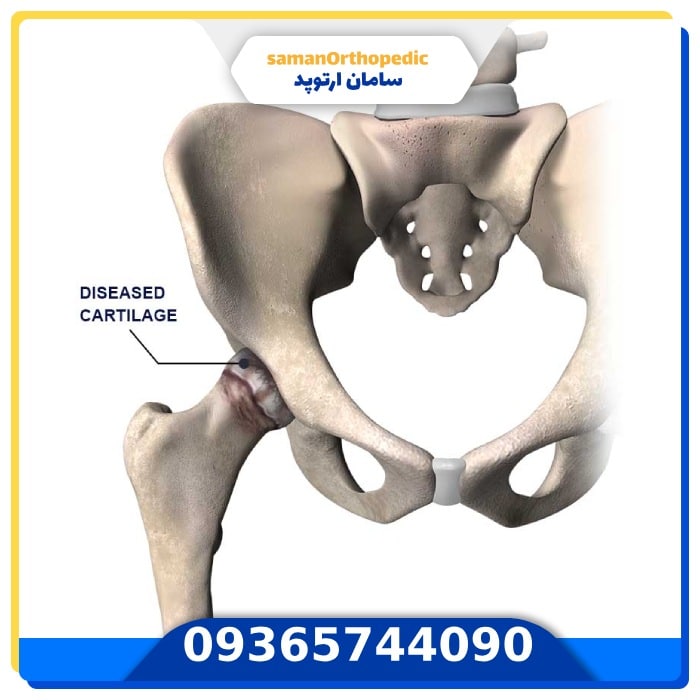 عمل جراحی تعویض مفصل لگن