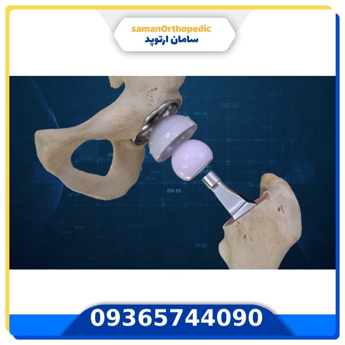 عمل جراحی تعویض مفصل لگن