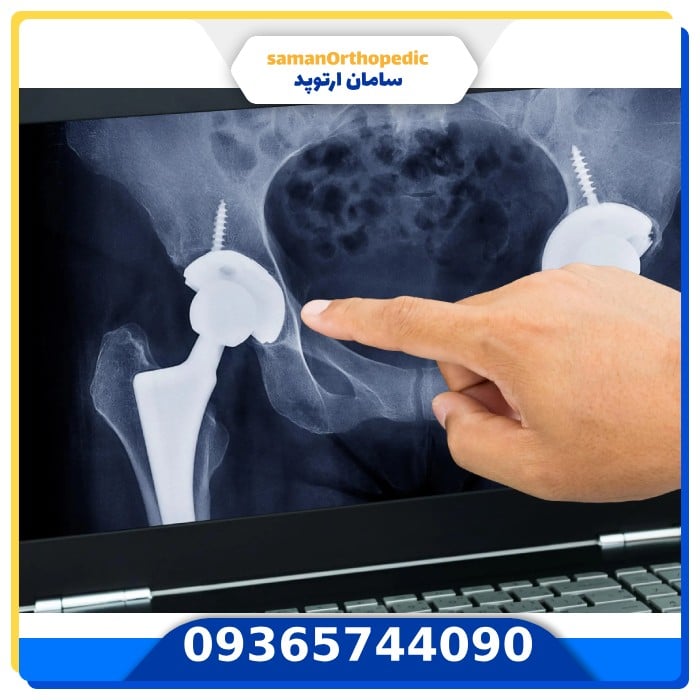 تعویض مجدد مفصل لگن