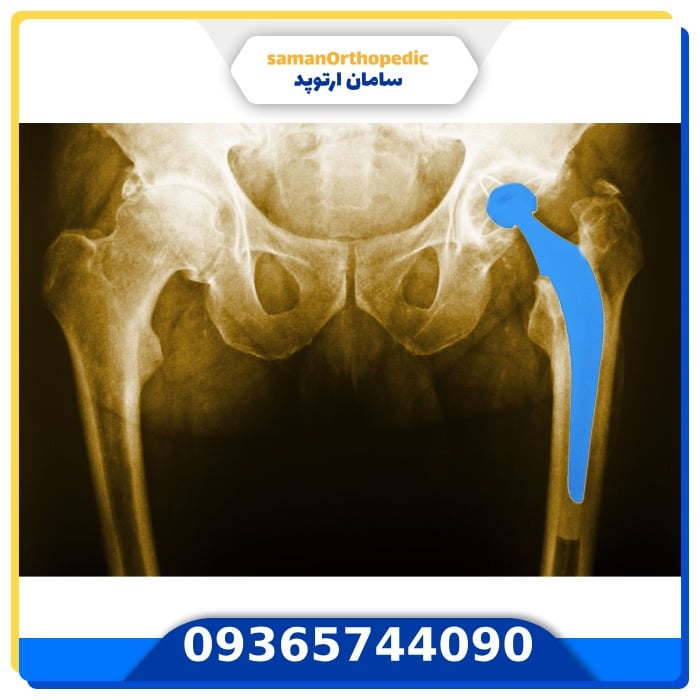 تعویض مجدد مفصل لگن
