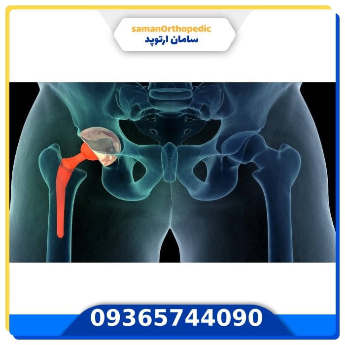 تعویض مجدد مفصل لگن