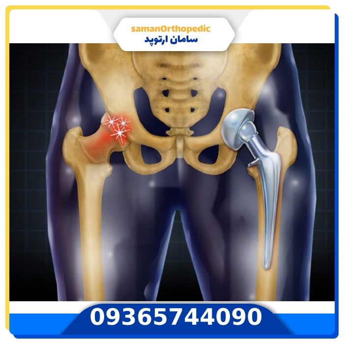 تعویض مجدد مفصل لگن