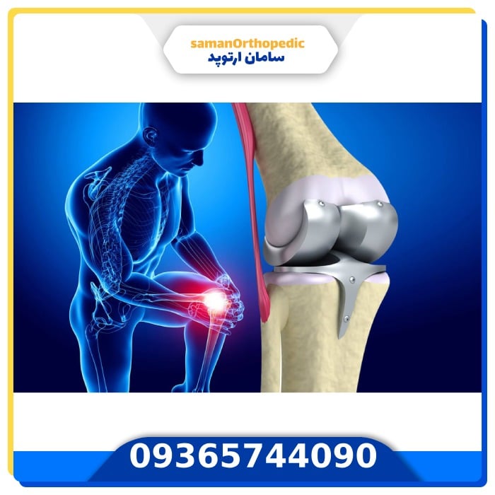عمل جراحی تعویض مجدد مفصل زانو