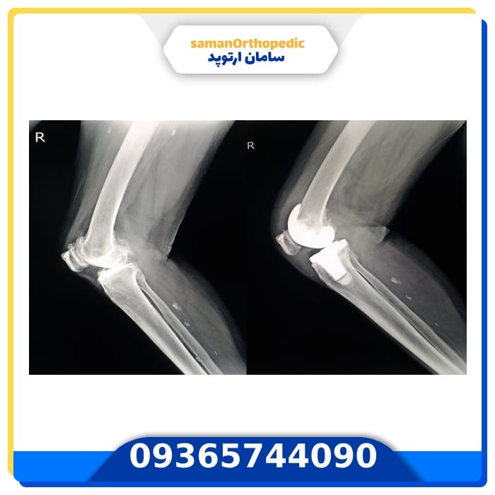 عمل جراحی تعویض مجدد مفصل زانو