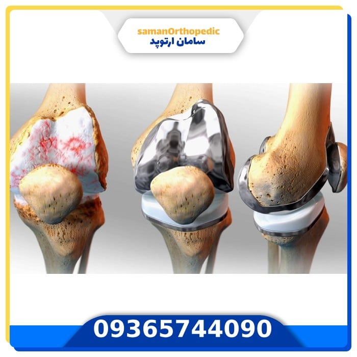 عمل جراحی تعویض مجدد مفصل زانو