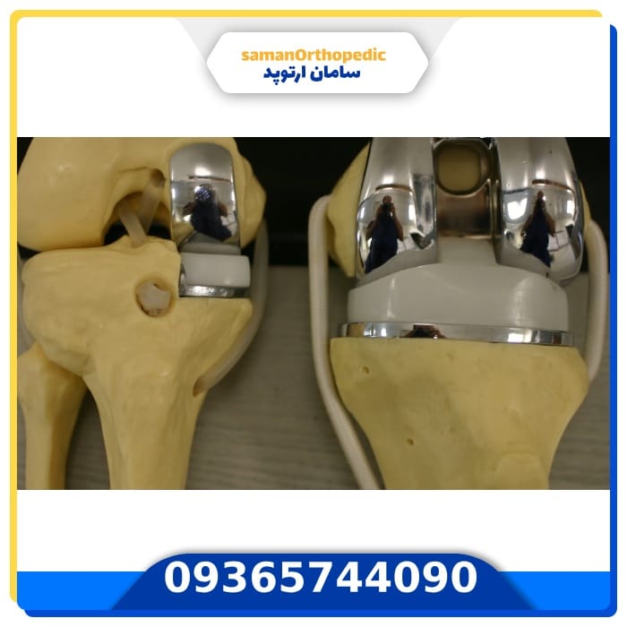 عمل جراحی تعویض مجدد مفصل زانو